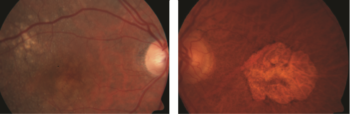 Figure 1. Dry AMD. A. Drusen (indicated by arrow). B. Geographic atrophy Photo courtesy Anat Loewenstein, MD