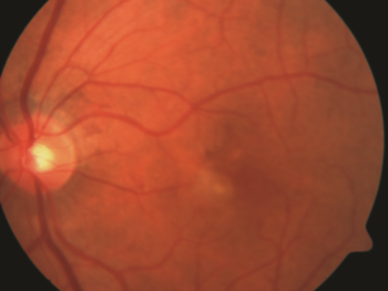 Figure 2. Wet AMD. Choroidal neovascularization (indicated by arrow). Photo courtesy Anat Loewenstein, MD