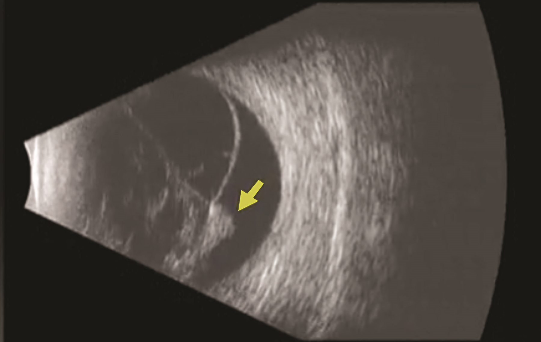 Figure 2. B-scan ultrasound of a patient with PVR-related retinal detachment. A fixed retinal fold (yellow arrow) is seen with a cone-shaped retinal detachment. (Photo courtesy of Yale Fisher, MD. Retina Image Bank, © American Society of Retina Specialists.)