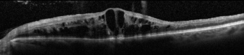 Figure 2. OCT of an acute CRVO with severe macular edema. Image courtesy of John Thompson, MD
