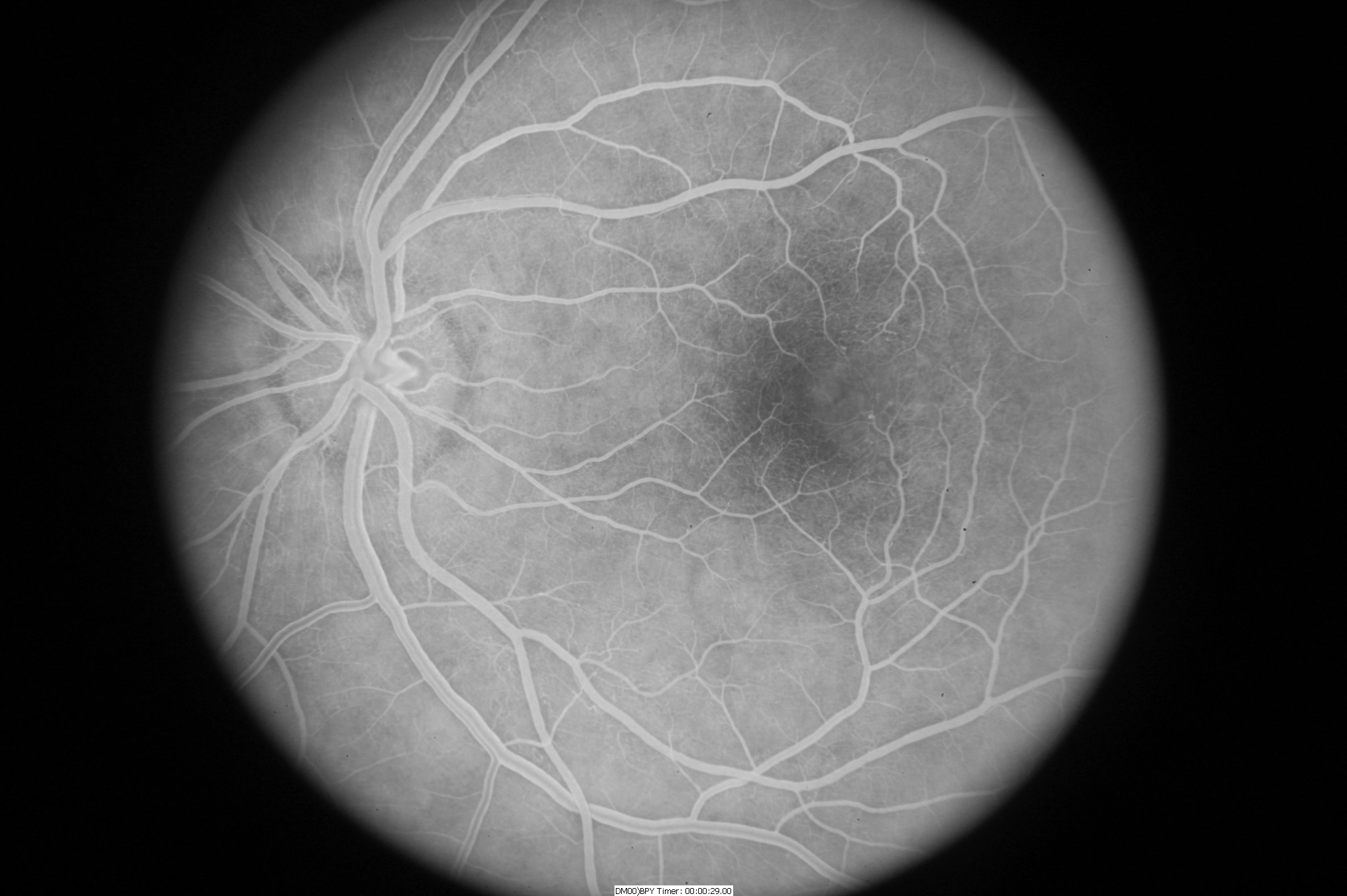 Early frames of the fluorescein angiogram show telangiectatic vessels in temporal macula. Image courtesy of John Thompson, MD