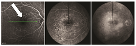 Figure 1. Fluorescein angiography: Macular edema may be seen as a pinpoint leak (left, large arrow) in mild cases. In serious cases, macular edema may diffusely involve the macula. Note how the image becomes brighter and more diffuse as more dye leaks from damaged macular capillaries (center and right). (Images courtesy of the ASRS Retina Image Bank, contributed by Dr. Suber Huang)