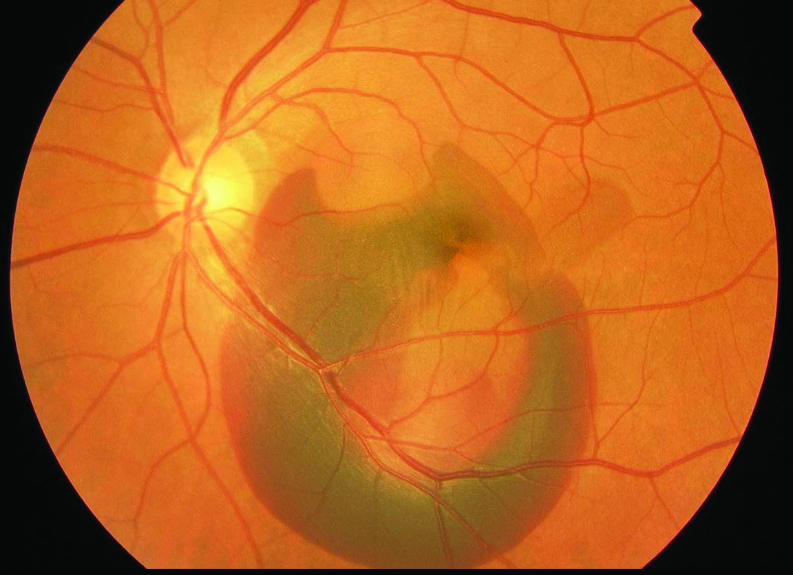 Figure 1.Significant amount of subretinal blood in the macula of a left eye caused by PCV. Image courtesy of the ASRS Retina Image Bank, contributed by Yusuke Oshima, MD, PhD. Osaka University Graduate School of Medicine, 2013. Copyright American Society of Retina Specialists 2016