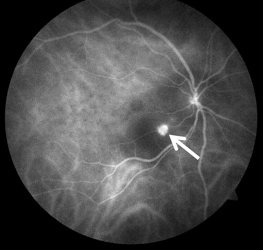Figure 2. ICG angiography revealing abnormal, balloonshaped “polyp” in center of right macula (arrow). Image courtesy of the ASRS Retina Image Bank, contributed by John S. King, MD, 2014. Copyright American Society of Retina Specialists 2016