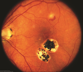 Figure 1. Color fundus photograph of the right eye of a patient with POHS shows typical punched out scars and peripapillary atrophy. Henry Kaplan, MD. Presumed Ocular Histoplasmosis Syndrome. Retina Image Bank 2013; Image 4951. © the American Society of Retina Specialists.