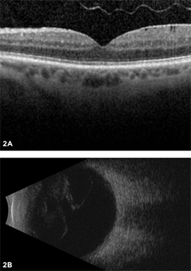 Figure 2. Most posterior vitreous detachments can be diagnosed with a dilated eye exam. However, OCT (A) and B-scan ultrasound (B) are diagnostic tests that can be helpful in diagnosing PVD.