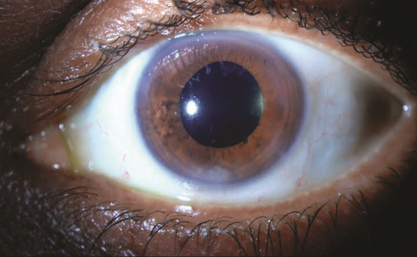 Retained Lens Fragments Jason Calhoun, MD. Mayo Clinic Jacksonville Florida. Retina Image Bank 2013; Image 7743. ©American Society of Retina Specialists