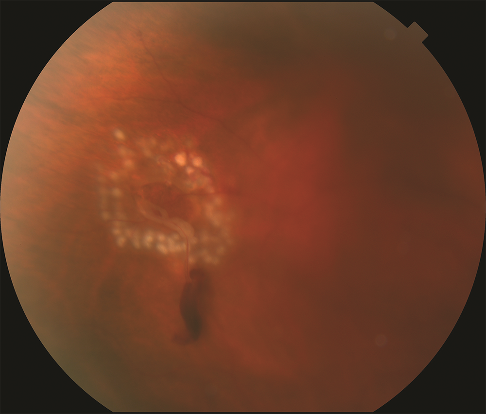 Figure 1. Laser photocoagulation around retinal tear with small hemorrhage. Photo courtesy of Larry Halperin, MD