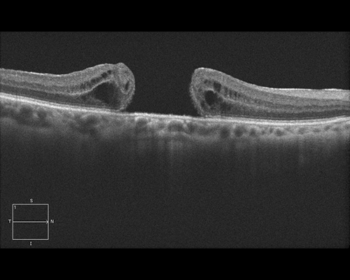 Figure 3c. A full-thickness macular hole is shown using enhanced-depth imaging optical coherence tomography (EDI-OCT). The macula is pulled apart by traction on the surface of the retina. The dark areas represent swelling (retinal edema) from tissue damage. Vitrectomy surgery removes this traction and allows the retina to slide together, closing the gap and restoring the “hole” in the patient’s vision. Image courtesy of the ©ASRS Retina Image Bank, contributed by Mr. Jason Calhoun. Image 7267.