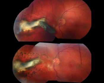 Figure 3f. A fragment of metal (upper photo) punctures the eye and impales (pierces) the retina near the optic nerve. Vitrectomy surgery was performed to remove the intraocular (in-the-eye) foreign body and laser was placed to prevent retinal detachment (black spots surrounding the white scar in lower photo). Image courtesy of the ©ASRS Retina Image Bank, contributed by Ahmad Tarabishy, MD. Image 24834.