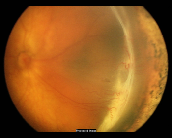 Figure 3g. Traction retinal detachment involving the macula in retinopathy of prematurity (ROP) (Stage 4b ROP). Contracture of abnormal blood vessels forms an elevated ridge of scar tissue in an infant with severe prematurity. Image courtesy of ©ASRS Retina Image Bank, contributed by Audina Berrocal, MD. Image 1198.