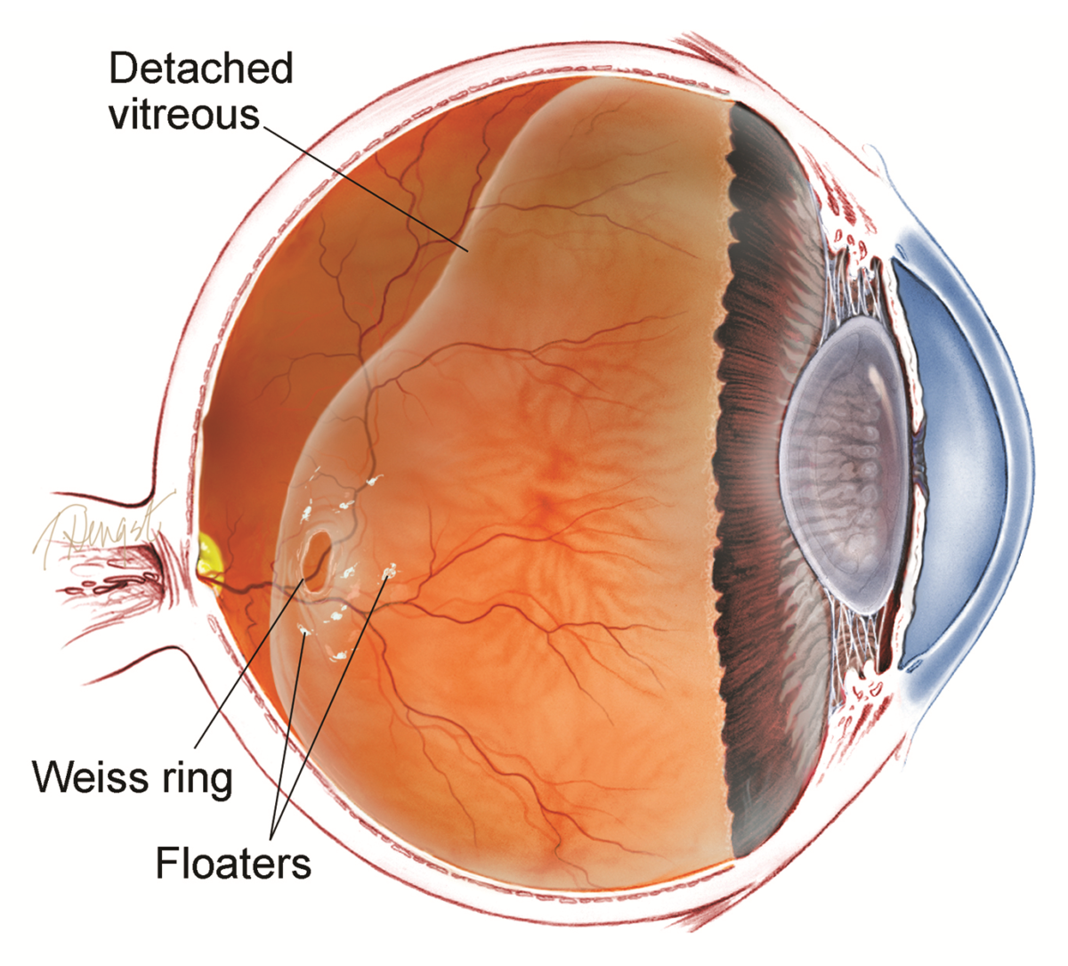new research on vitreous floaters